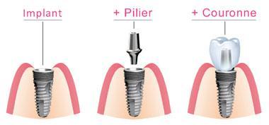 composants implant dentaire